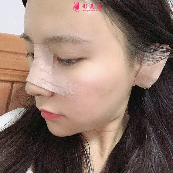 立場(chǎng)簡(jiǎn)單的整形術(shù)后圖片