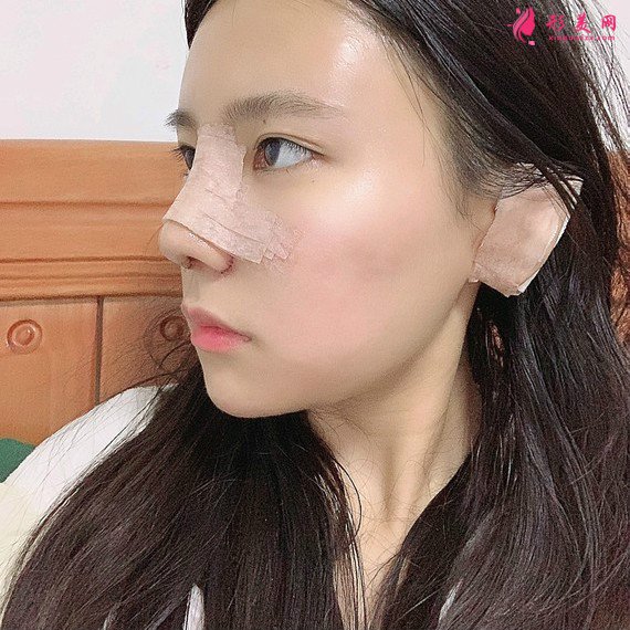 立場(chǎng)簡(jiǎn)單的整形術(shù)后圖片
