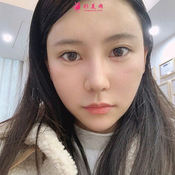 立場(chǎng)簡(jiǎn)單的整形術(shù)后圖片