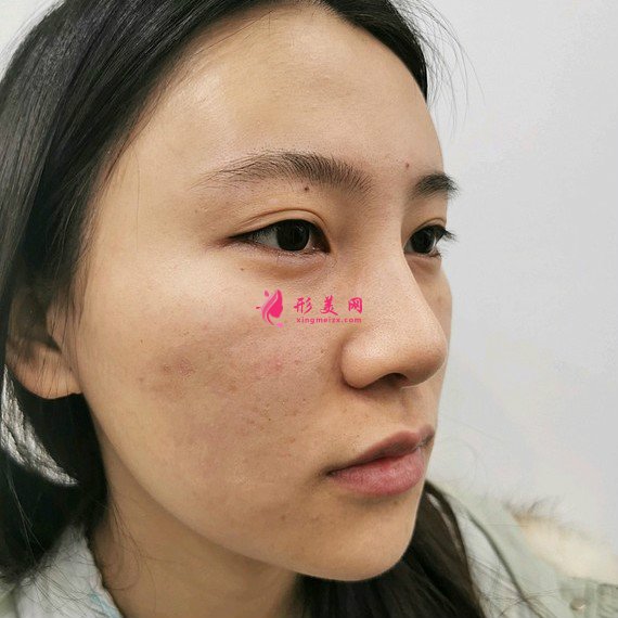 整形前后對(duì)比圖片