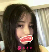 上海東方醫(yī)院整形科鷹鉤鼻矯正案例 恢復(fù)過程對比圖