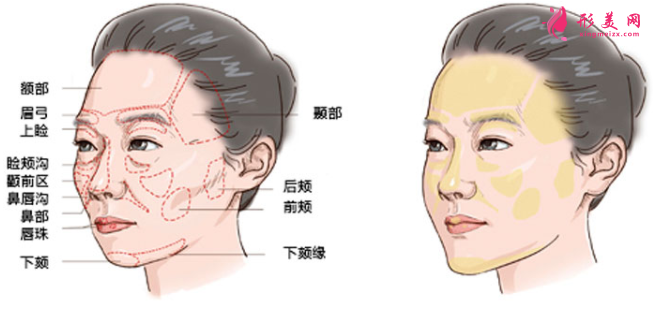 自體脂肪填充臉部會有血腫嗎
