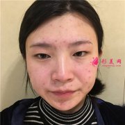 成都藝星醫(yī)療美容醫(yī)院切開雙眼皮術(shù)后恢復(fù)情況對比