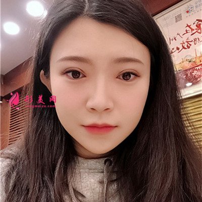 成都切開雙眼皮術后恢復情況對比