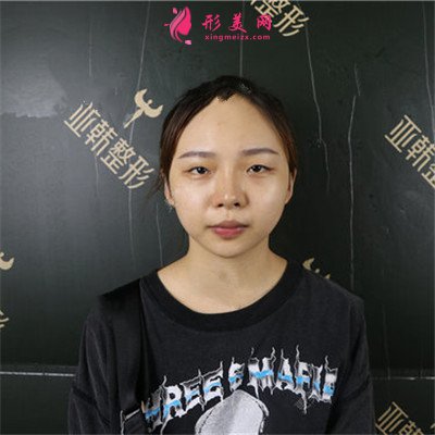 武漢小姐姐的眼綜合術(shù)后效果展示