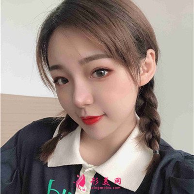 武漢小姐姐的眼綜合術(shù)后效果展示