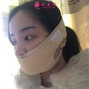 鄭州附二院吸脂瘦臉術(shù)后恢復(fù)情況對比