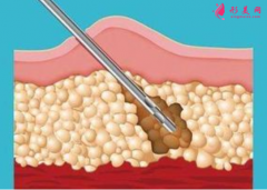 腰腹部吸脂后要按摩嗎？