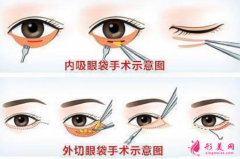 手術(shù)祛眼袋的恢復期要多久？
