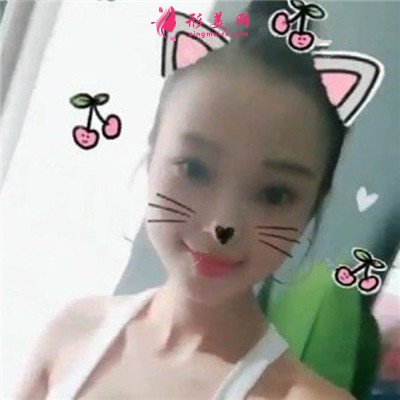 重慶發(fā)際線調整術后恢復效果對比