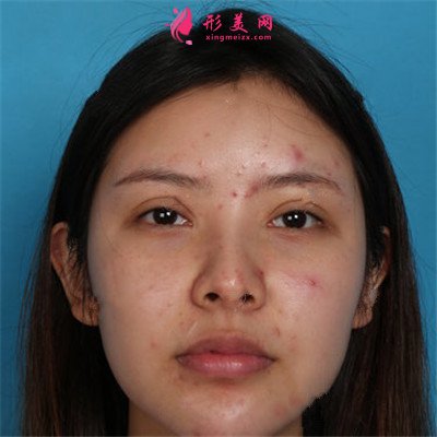 鄭州鼻綜合術(shù)后恢復(fù)效果對(duì)比