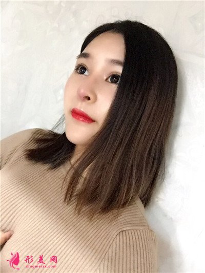 鄭州膨體隆鼻術(shù)后恢復(fù)情況對(duì)比
