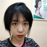 重慶軍科整形醫(yī)院小姐姐埋線雙眼皮術(shù)后恢復(fù)情況反饋