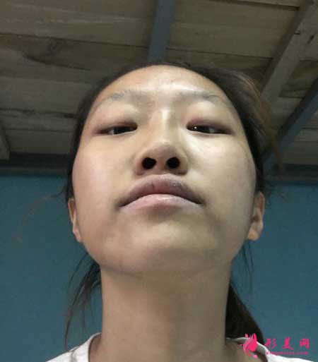 去上海九院做了下頜角截骨手術(shù),我也是精致小臉了