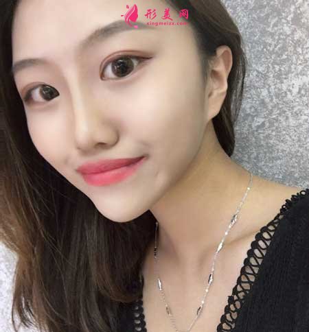 去上海九院做了下頜角截骨手術(shù),我也是精致小臉了