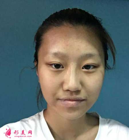 去上海九院做了下頜角截骨手術(shù),我也是精致小臉了