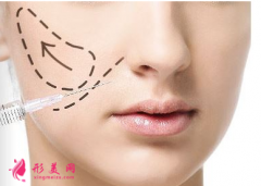 臉部填充玻尿酸可以保持多久？