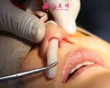 隆鼻假體取出后要注意的事項