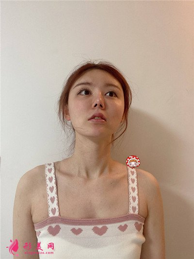 鄭州做M唇手術術后恢復效果反饋