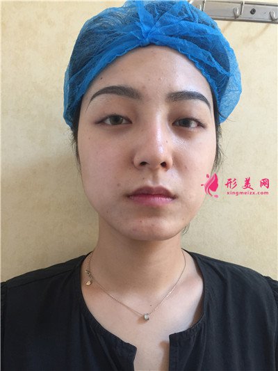 成都小姐姐切開雙眼皮術(shù)后恢復(fù)情況分享