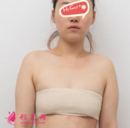 上海九院假體隆胸后變身性感女人 不用擠都有溝