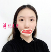 上海九院整形科鷹鉤鼻矯正前后照片對比 360度無死角