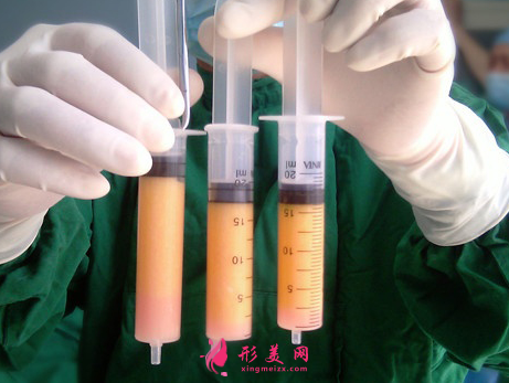 自體脂肪填充臉部消腫時(shí)間