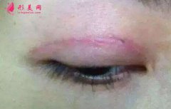 雙眼皮術(shù)后一個(gè)月疤痕明顯怎么辦