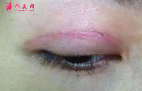 雙眼皮術后一個月疤痕明顯怎么辦