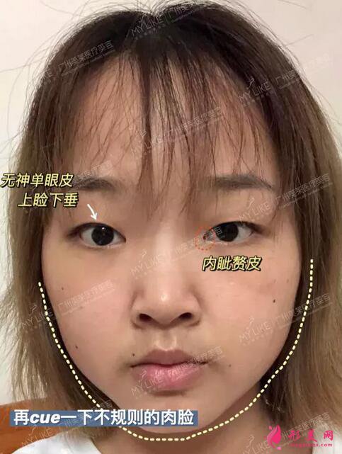 廣州美萊雙眼皮案例|單眼皮妹子30天の變美日記~