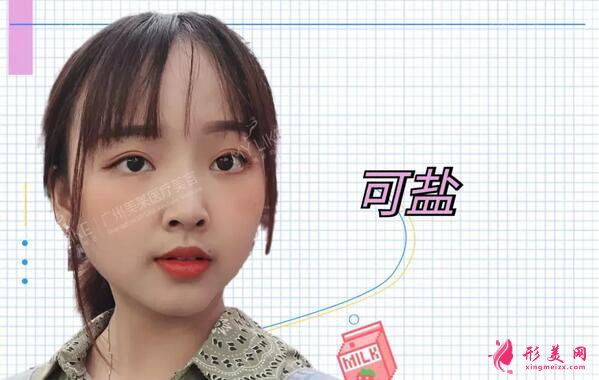 廣州美萊雙眼皮案例|單眼皮妹子30天の變美日記~