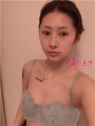 成都圣丹福整形美容醫(yī)院假體隆胸術(shù)后恢復(fù)情況對比分享