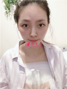 重慶模特小姐姐假體隆胸術(shù)后恢復(fù)情況分享