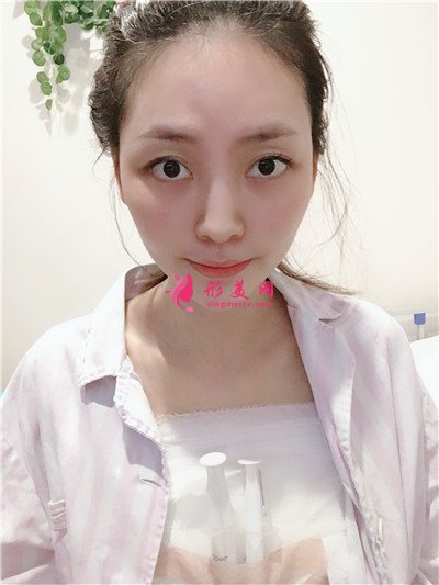 重慶模特小姐姐假體隆胸術(shù)后恢復(fù)情況分享