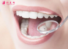 烤瓷牙邊緣變黑是怎么回事
