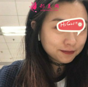 濟(jì)南愛容整形美容醫(yī)院熱瑪吉提升 皮膚緊致有彈性 美美噠