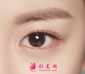 開(kāi)眼角后疤痕增生怎么修復(fù)