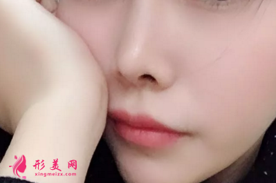 假體隆鼻恢復(fù)期會(huì)影響工作嗎