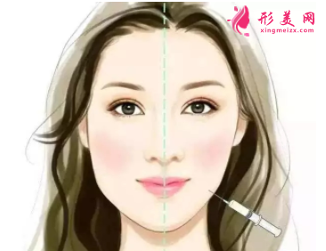 注射瘦臉針效果如何