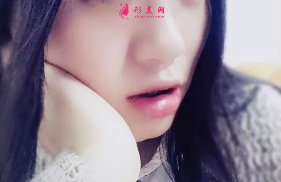 注射瘦臉針效果如何