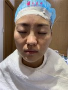北京京民整形外科面部埋線提升術(shù)后恢復(fù)情況反饋