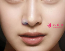 鼻翼縮小手術(shù)方式有多少種？