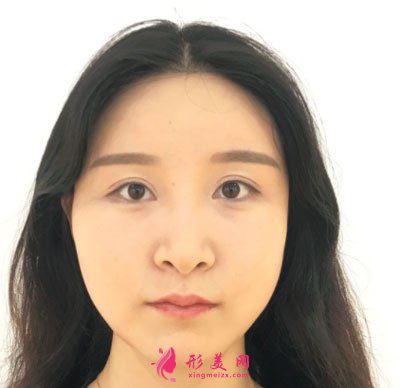 上海華美醫(yī)療美容醫(yī)院V-LINE瓜子臉手術案例
