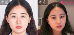 到廈門美萊醫(yī)療美容醫(yī)院做的眼部多項(xiàng)怎么樣？真人案例對(duì)比分
