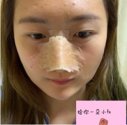 重慶新橋醫(yī)院整形科價格表，隆鼻案例分享