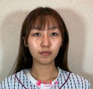 寧波韓美美容醫(yī)院自體脂肪面部填充真人案例來了，術(shù)前術(shù)后對(duì)比圖