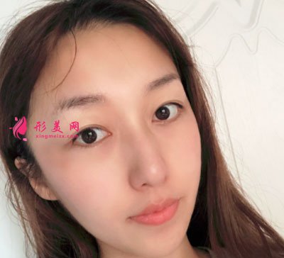 寧波靜港整形自體脂肪面部填充案例