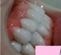杭州格萊美醫(yī)院整牙價格表，看牙齒矯正術(shù)后效果實拍