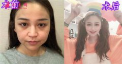 杭州瑞麗整形美容醫(yī)院隆鼻 怎么樣？ 案例_價(jià)格_醫(yī)生_對(duì)比圖