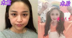 杭州瑞麗整形美容醫(yī)院隆鼻怎么樣？案例對(duì)比圖